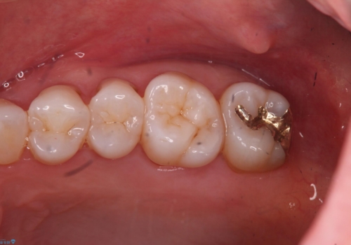 奥歯の深くて確認しにくい虫歯　ゴールドインレーでの治療の治療後