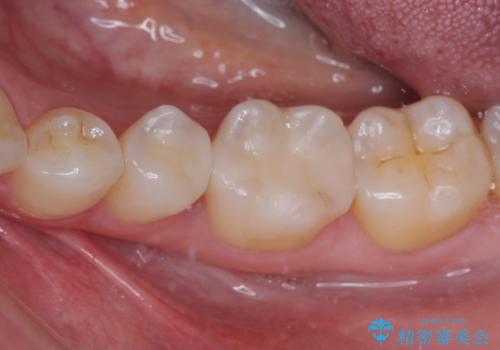 銀歯をセラミックにしたい セラミックインレー修復の治療後