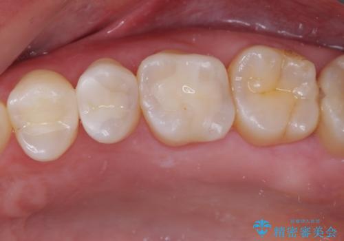 銀歯をセラミックにしたい セラミックインレー修復の治療後