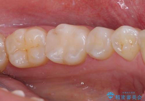 銀歯をセラミックにしたい セラミックインレー修復の治療後