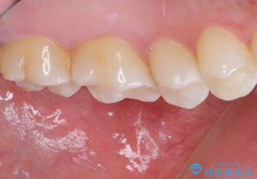 銀歯をセラミックにしたい セラミックインレー修復の治療後