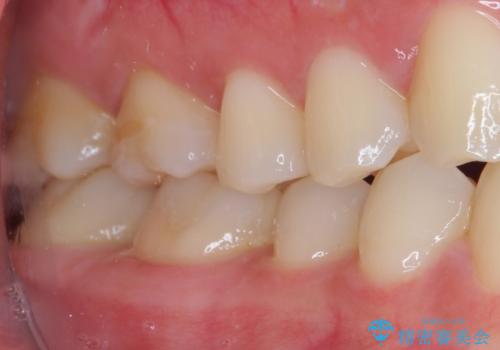 銀歯をセラミックにしたい セラミックインレー修復の治療後