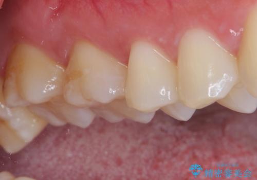 銀歯をセラミックにしたい セラミックインレー修復の治療後