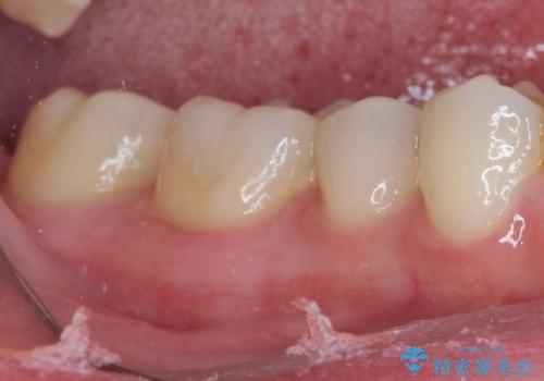 銀歯をセラミックにしたい セラミックインレー修復の治療後