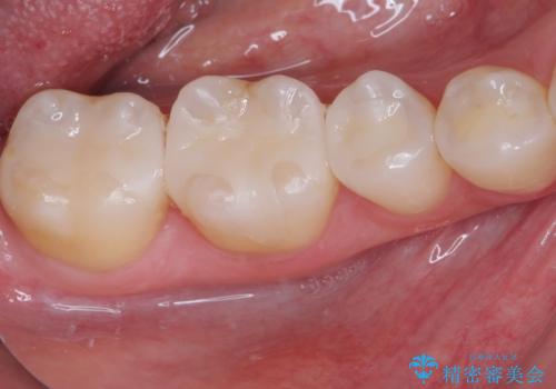 銀歯をセラミックにしたい セラミックインレー修復の治療後