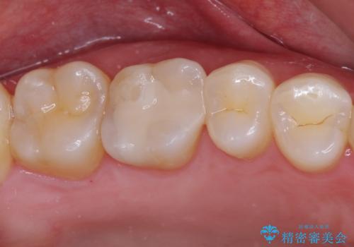 銀歯をセラミックにしたい セラミックインレー修復の治療後