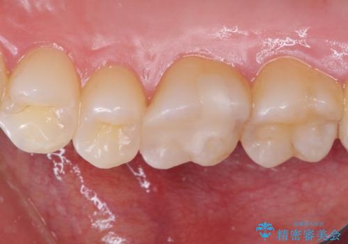 銀歯をセラミックにしたい セラミックインレー修復の治療後