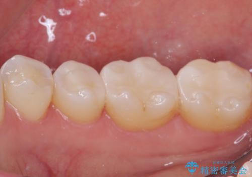 銀歯をセラミックにしたい セラミックインレー修復の治療後