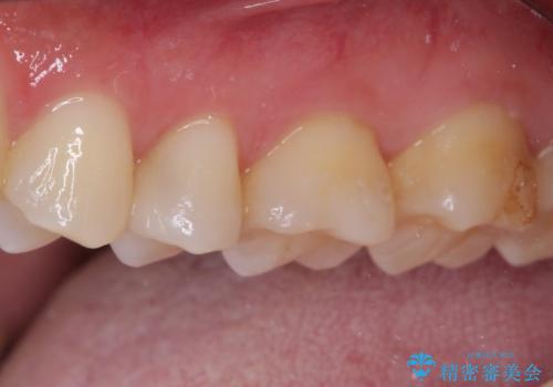 銀歯をセラミックにしたい セラミックインレー修復の治療後