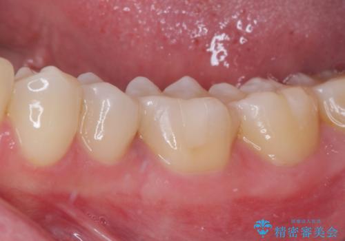 銀歯をセラミックにしたい セラミックインレー修復の治療後