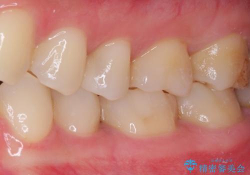 銀歯をセラミックにしたい セラミックインレー修復の治療後
