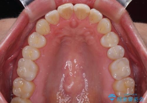 銀歯をセラミックにしたい セラミックインレー修復の治療後