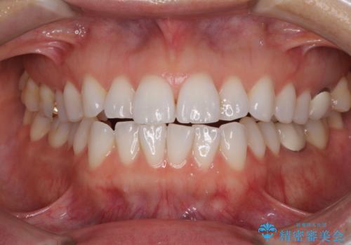 ちょっとしたデコボコをしっかりと改善したい インビザライン矯正の症例 治療前