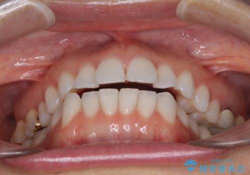 ちょっとしたデコボコをしっかりと改善したい インビザライン矯正の治療前