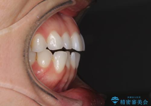 ちょっとしたデコボコをしっかりと改善したい インビザライン矯正の治療前