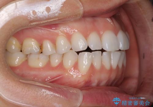 ちょっとしたデコボコをしっかりと改善したい インビザライン矯正の治療前