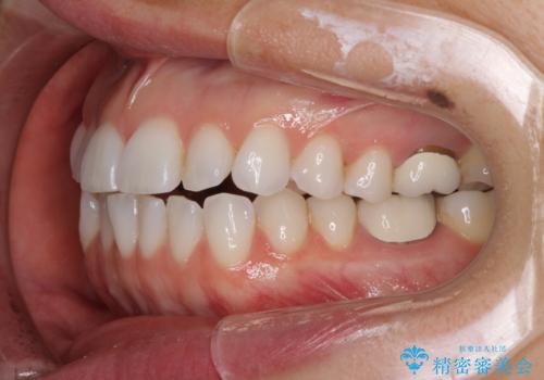 ちょっとしたデコボコをしっかりと改善したい インビザライン矯正の治療前