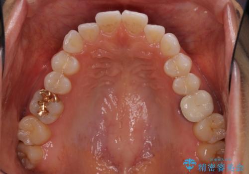 ちょっとしたデコボコをしっかりと改善したい インビザライン矯正の治療前