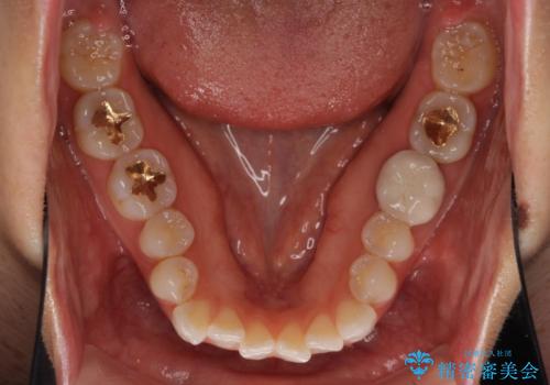 ちょっとしたデコボコをしっかりと改善したい インビザライン矯正の治療前