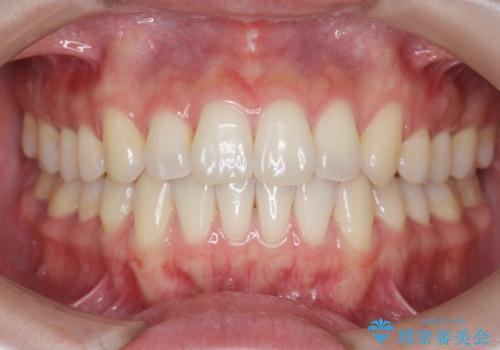 前歯のねじれを改善　マウスピース矯正インビザラインの症例 治療後