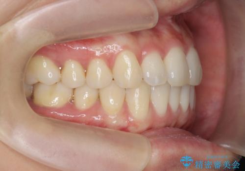 前歯のねじれを改善 マウスピース矯正インビザラインの治療後
