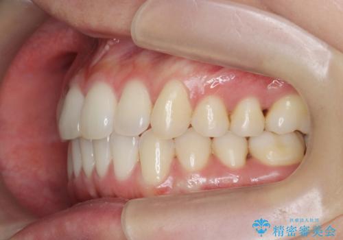 前歯のねじれを改善　マウスピース矯正インビザラインの治療後