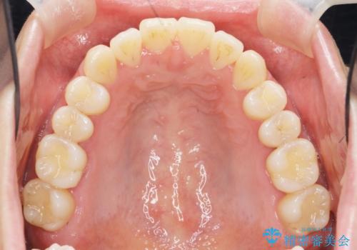 前歯のねじれを改善 マウスピース矯正インビザラインの治療後