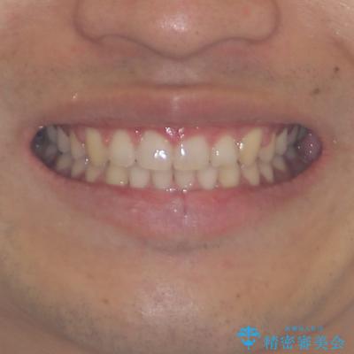 深い咬み合わせと隙間の空いた歯列をワイヤー矯正で改善の治療後（顔貌）