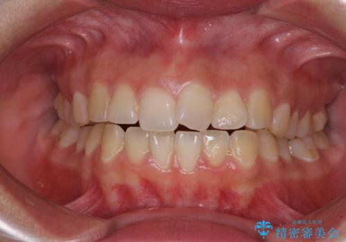 【モニター】カリエールディスタライザーとインビザラインを用いた奥歯の咬み合わせ改善の症例 治療前