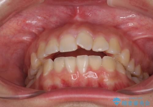 【モニター】カリエールディスタライザーとインビザラインを用いた奥歯の咬み合わせ改善の治療前