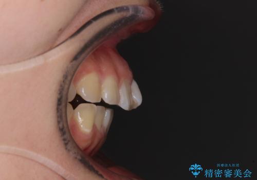 【モニター】カリエールディスタライザーとインビザラインを用いた奥歯の咬み合わせ改善の治療前