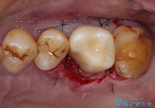 食事で割れてしまった奥歯 外科処置を用いた補綴治療の治療中