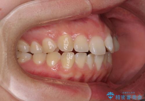 【モニター】カリエールディスタライザーとインビザラインを用いた奥歯の咬み合わせ改善の治療前