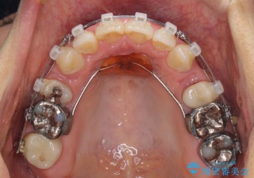 閉じにく口元と欠損歯列 ワイヤー装置の抜歯矯正の治療中