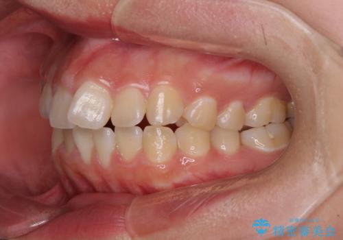 【モニター】カリエールディスタライザーとインビザラインを用いた奥歯の咬み合わせ改善の治療前