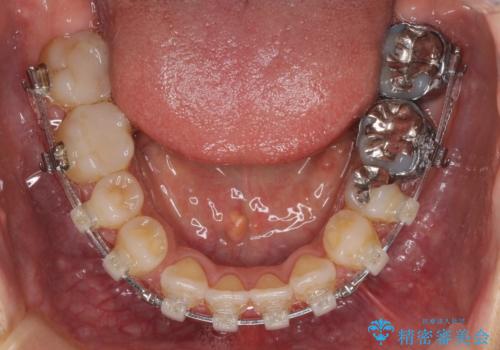 閉じにく口元と欠損歯列　ワイヤー装置の抜歯矯正の治療中