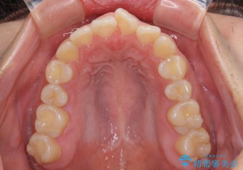 【モニター】カリエールディスタライザーとインビザラインを用いた奥歯の咬み合わせ改善の治療前