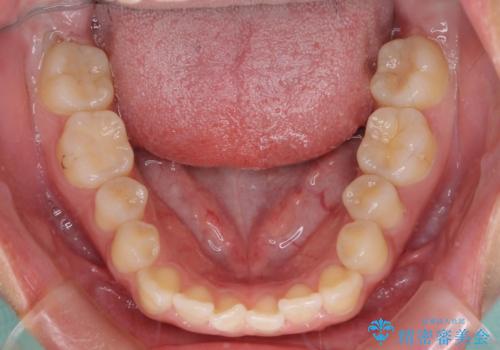 【モニター】カリエールディスタライザーとインビザラインを用いた奥歯の咬み合わせ改善の治療前