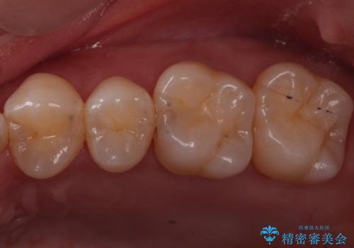 歯と歯の間の虫歯　ゴールドインレーでの修復の症例 治療前