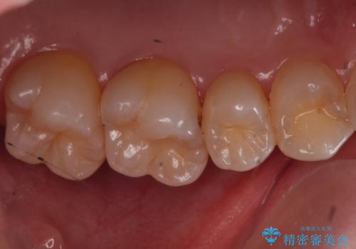 歯と歯の間の虫歯　ゴールドインレーでの修復の治療前