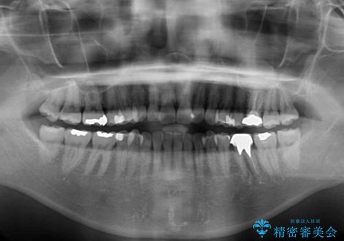 ちょっとしたデコボコをしっかりと改善したい インビザライン矯正の治療前