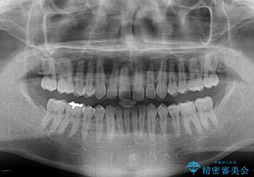 深い咬み合わせと隙間の空いた歯列をワイヤー矯正で改善の治療前