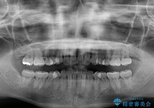 【モニター】インビザラインをしっかり使って短期間矯正治療の治療前
