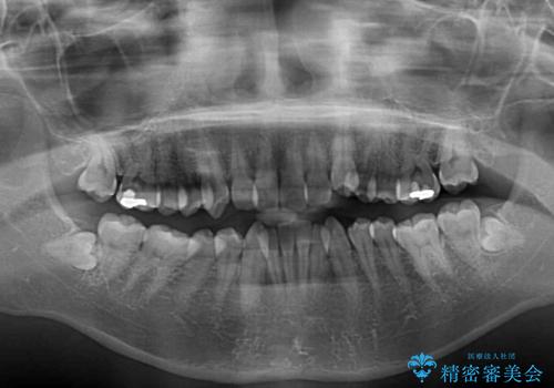 デコボコと八重歯の目立つ前歯 ワイヤー装置による抜歯矯正の治療前