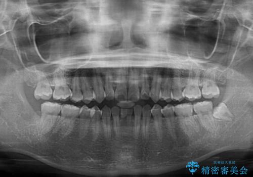 乳歯残存と欠損の前歯 矯正治療とオールセラミックブリッジ治療の治療前