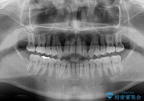 深い咬み合わせと隙間の空いた歯列をワイヤー矯正で改善の治療後