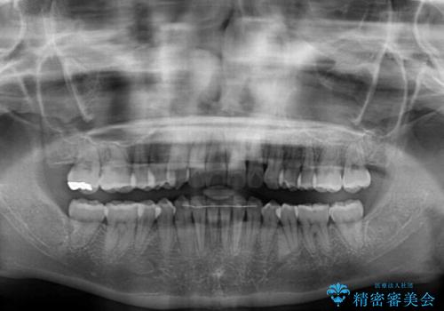 【モニター】インビザラインをしっかり使って短期間矯正治療の治療後