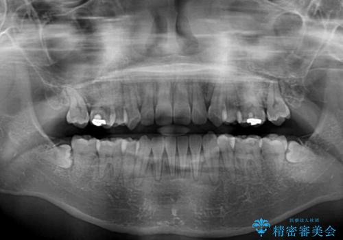 デコボコと八重歯の目立つ前歯 ワイヤー装置による抜歯矯正の治療後