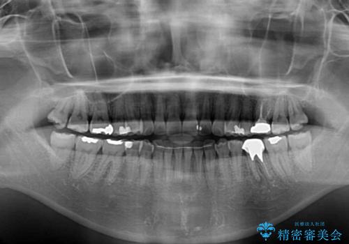 ちょっとしたデコボコをしっかりと改善したい インビザライン矯正の治療後