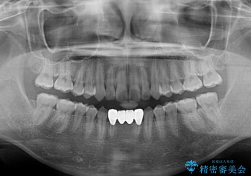 乳歯残存と欠損の前歯 矯正治療とオールセラミックブリッジ治療の治療後